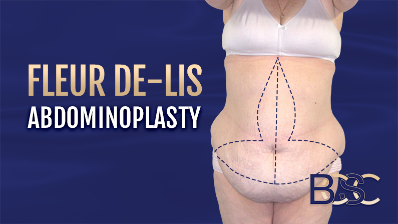 fleur de lis tummy tuck fleur de lis tummy tuck