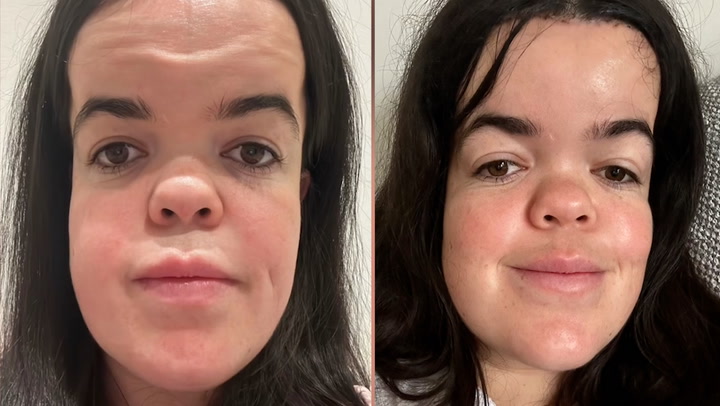 forehead reduction forehead reduction