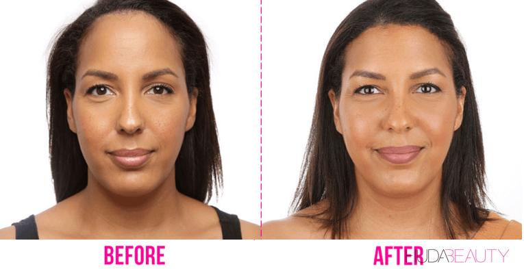 forehead reduction forehead reduction