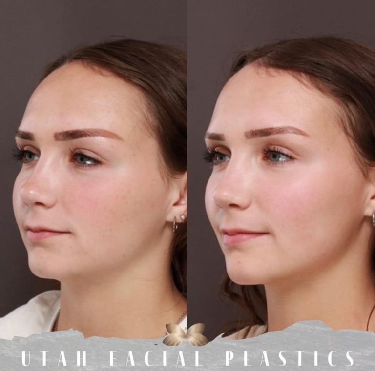 Forehead reduction: Reshaping for a proportional appearance