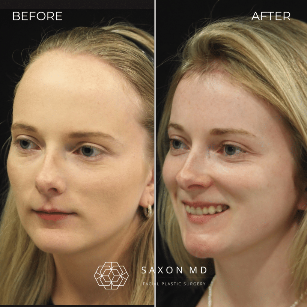 forehead reduction forehead reduction