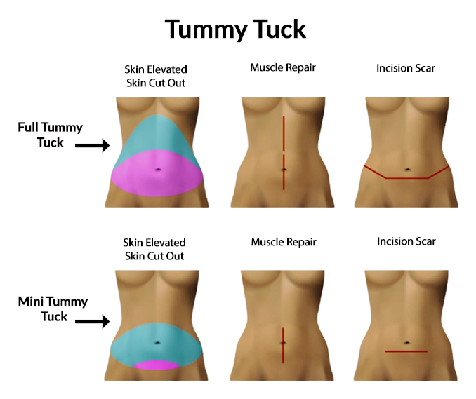 full tummy tuck full tummy tuck
