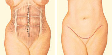 Full Tummy Tuck: Comprehensive abdominal contouring