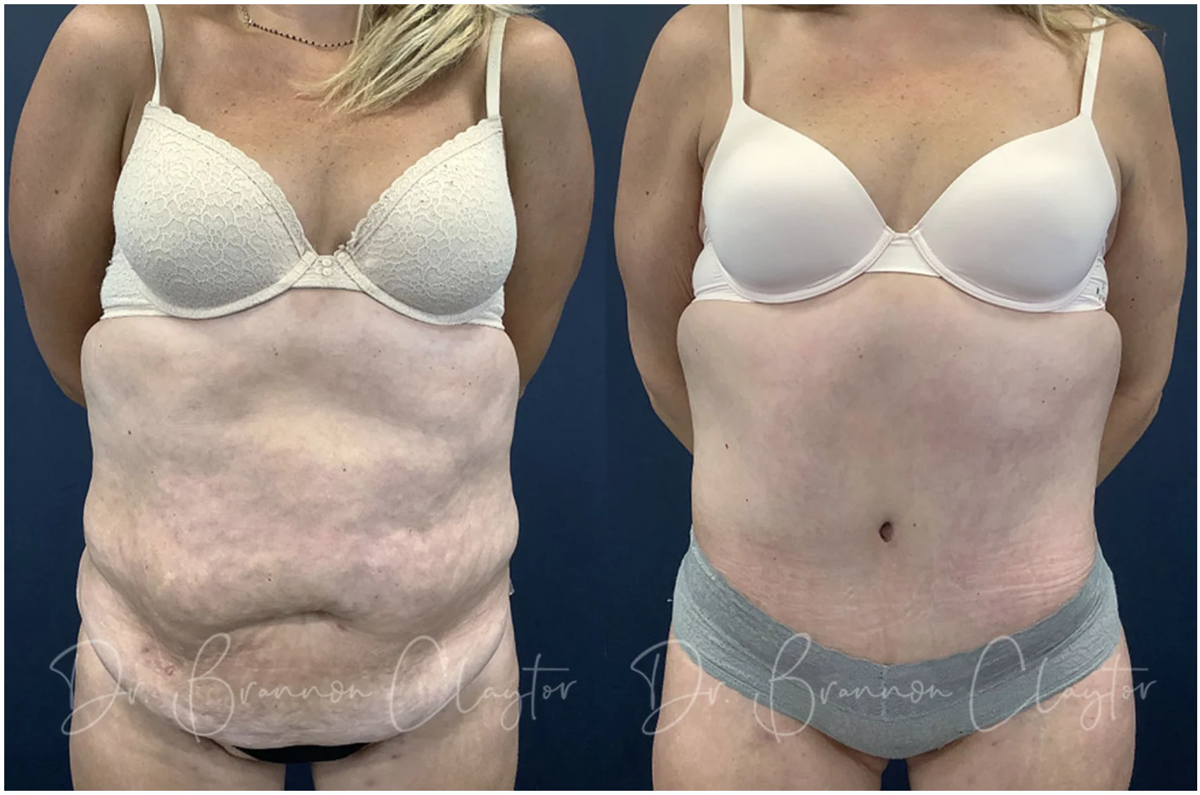 full tummy tuck full tummy tuck