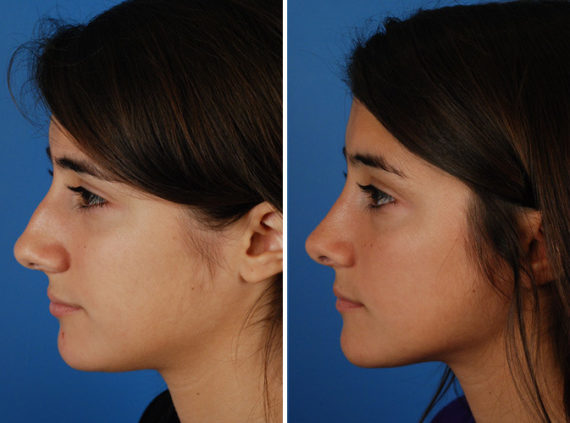 functional rhinoplasty