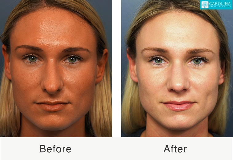 Functional Rhinoplasty: Restoring function and beauty