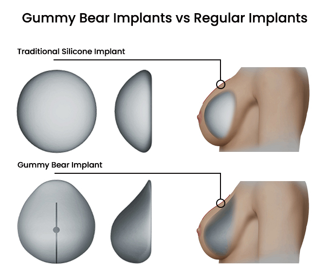 Gummy bear implants cost: Understanding expenses for cohesive gel implants