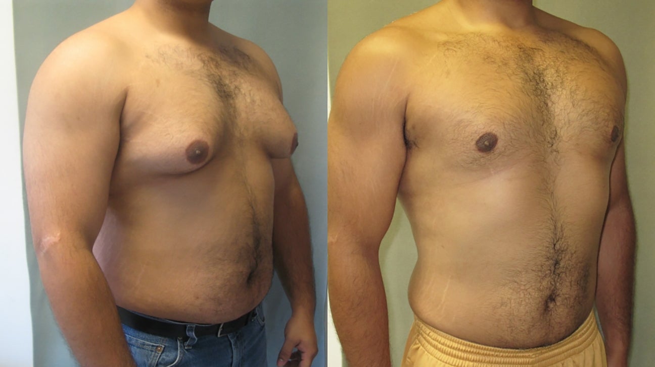 gynecomastia