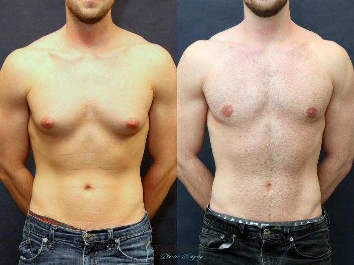 gynecomastia