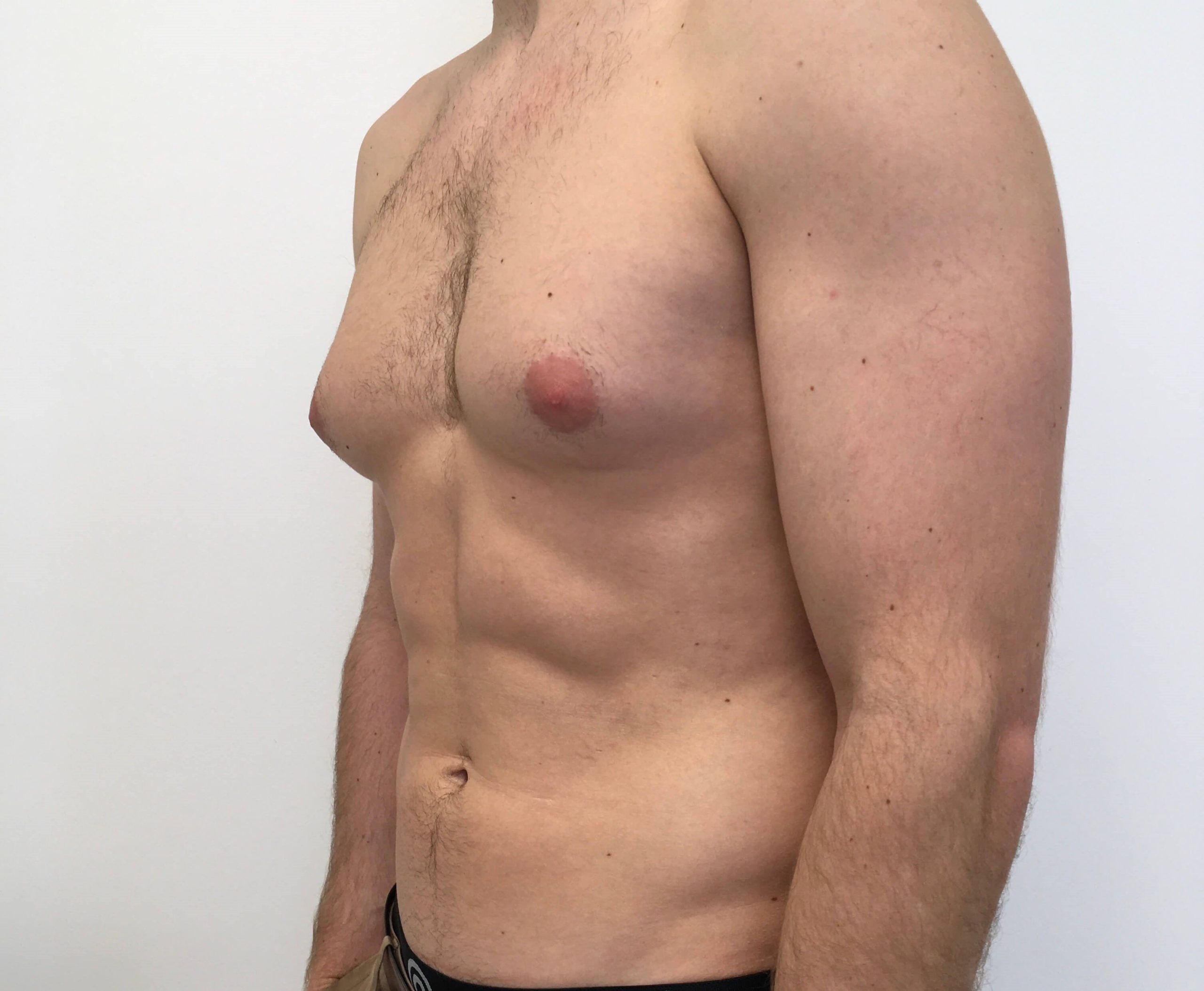 gynecomastia