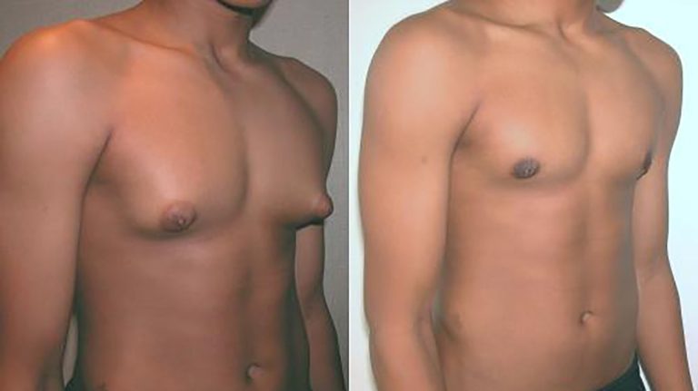 Gynecomastia: Reducing excess tissue for a masculine chest