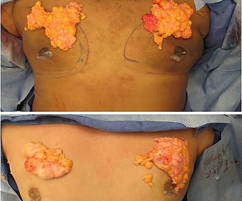 gynecomastia removal