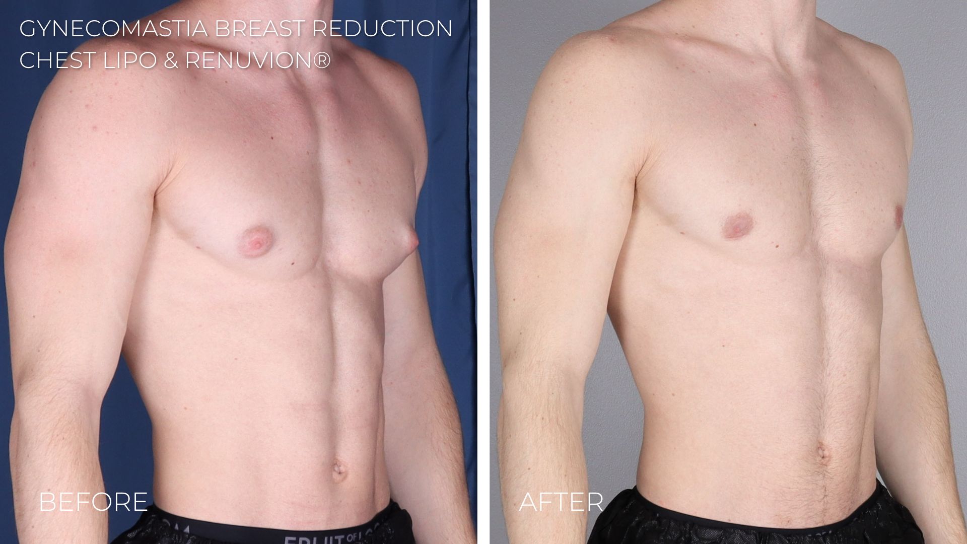 gynecomastia removal
