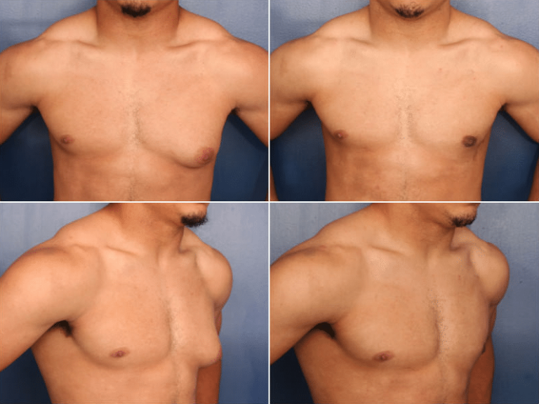 Gynecomastia Removal: Restoring male confidence