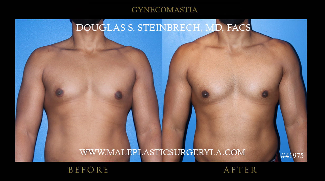 gynecomastia removal