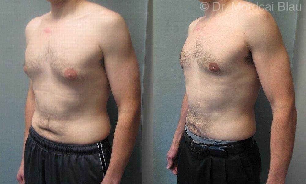 gynecomastia weight loss
