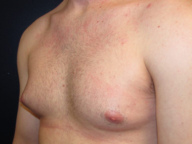 Gynecomastia Weight Loss: Non-surgical reduction options