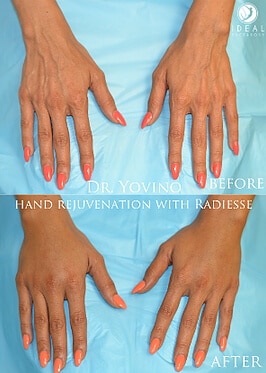 hand plastic surgery hand plastic surgery