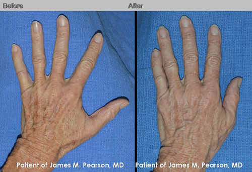 hand plastic surgery hand plastic surgery