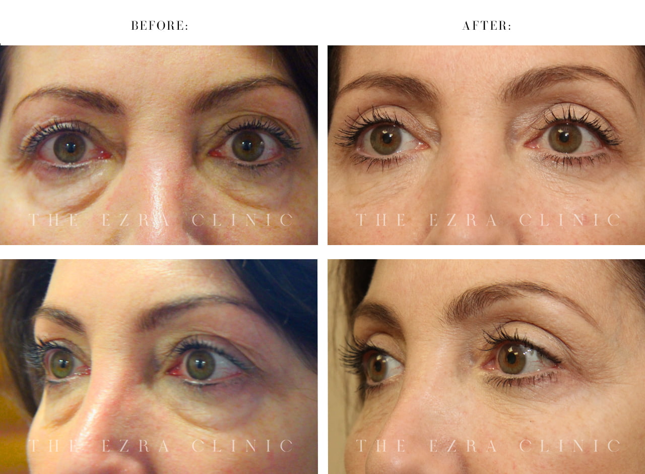 hooded eye surgery