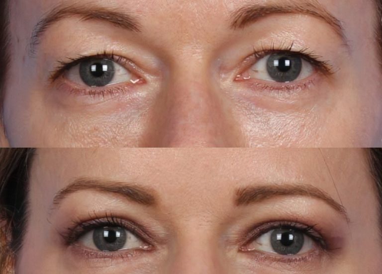Hooded eye surgery: Who is it for and what are the results