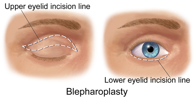 hooded eye surgery