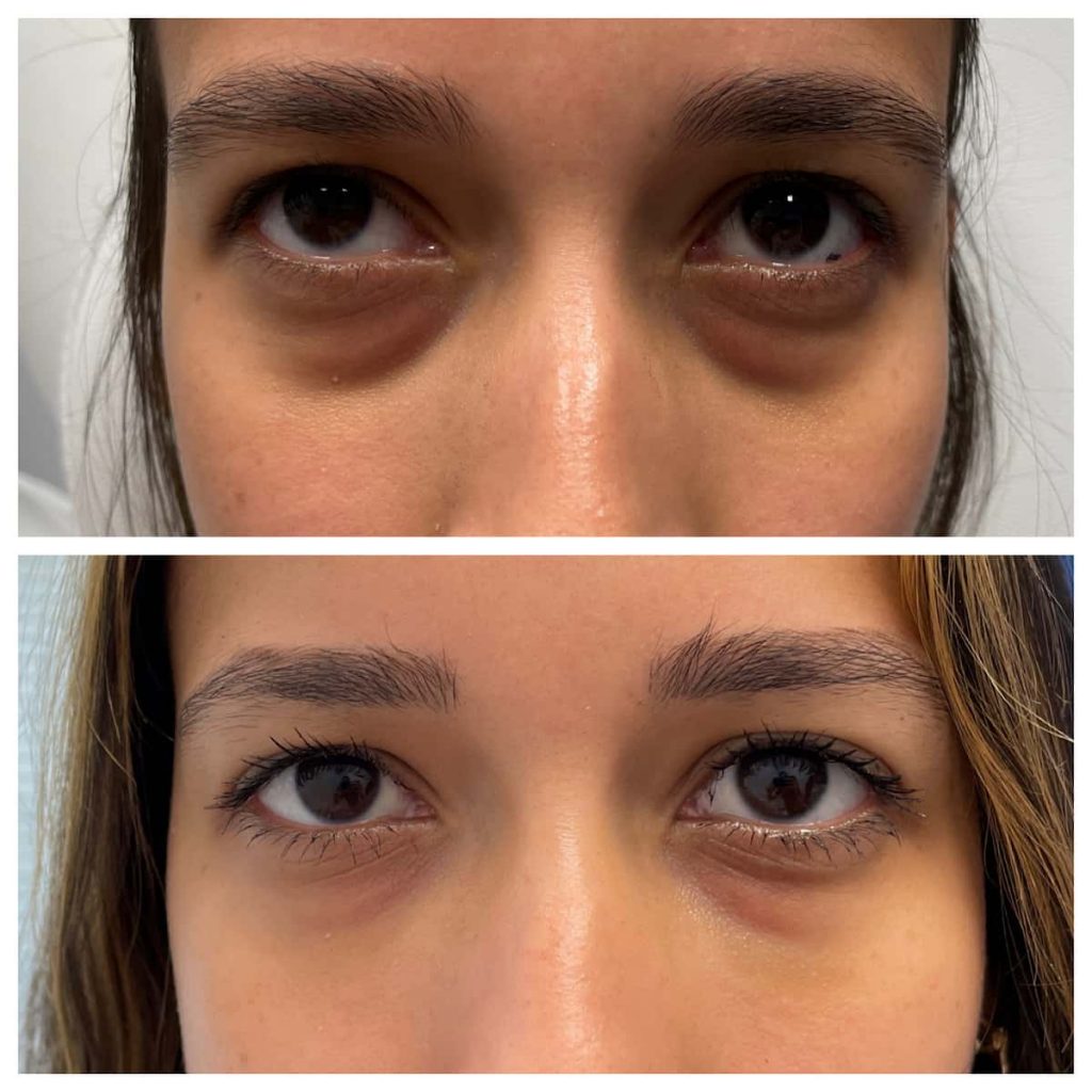 eyelid lifters