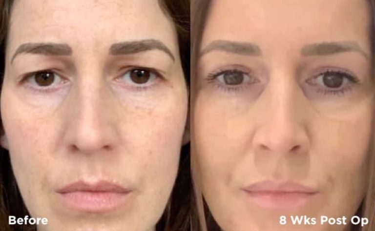 How eyelid lifters are transforming non-surgical beauty solutions