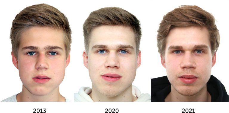 How face symmetry surgery can enhance your natural features