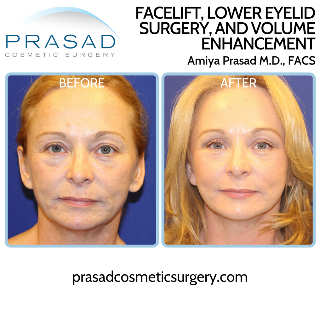 face symmetry surgery