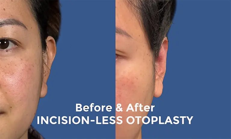 incisionless otoplasty incisionless otoplasty