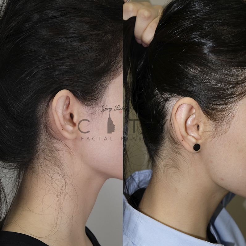 incisionless otoplasty incisionless otoplasty