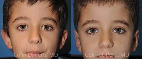 Incisionless otoplasty: Non-surgical options for ear reshaping