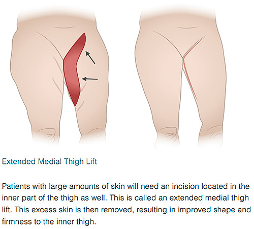 inner thigh lift inner thigh lift