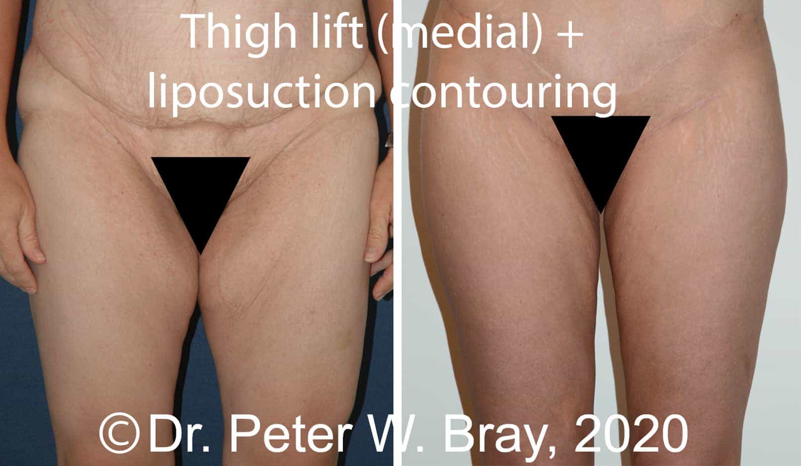 inner thigh lift inner thigh lift