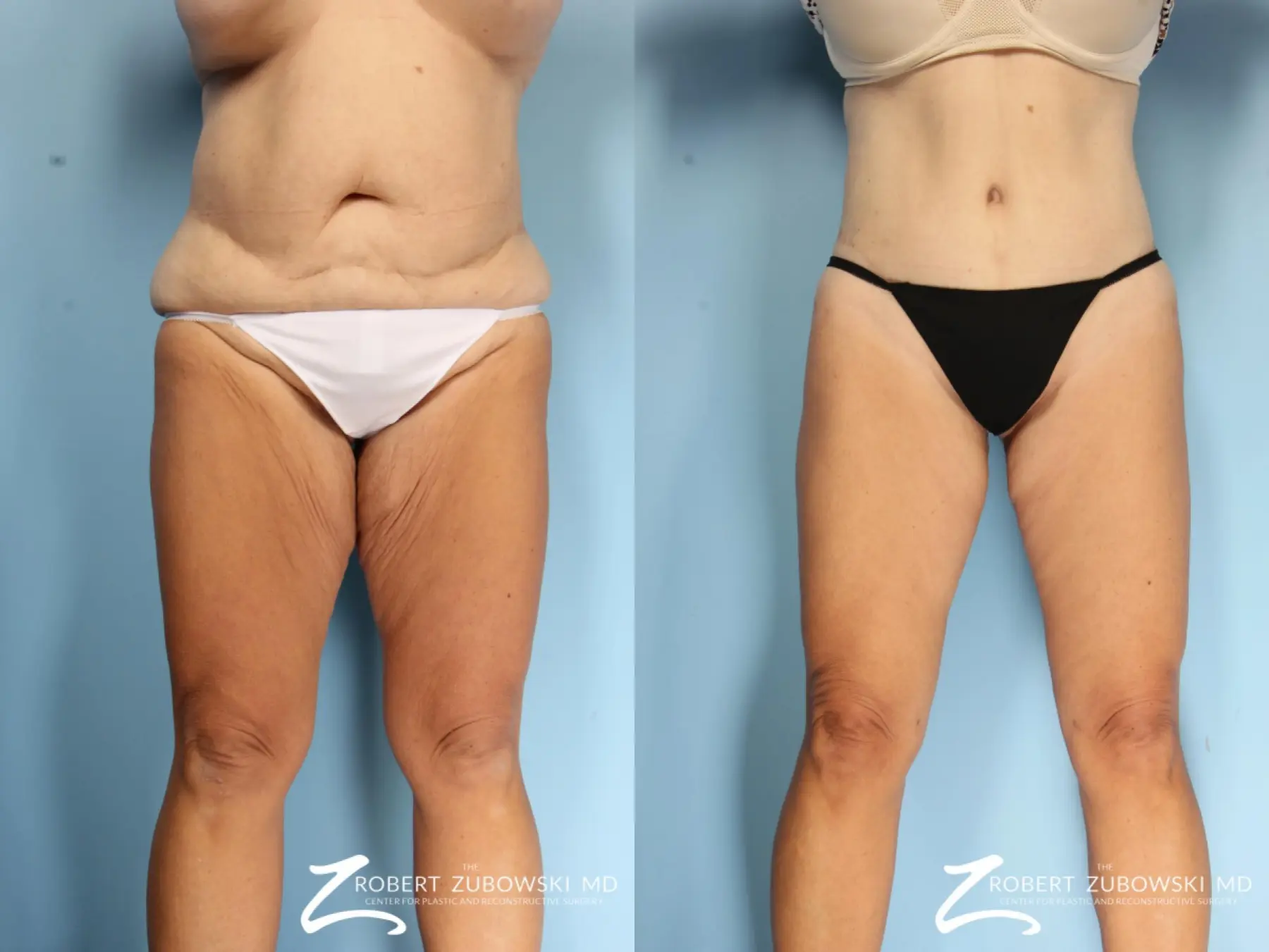 inner thigh lift inner thigh lift