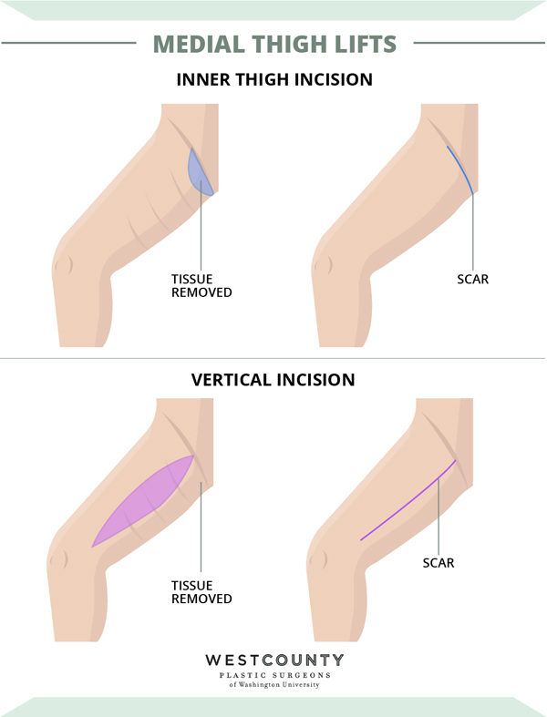 inner thigh surgery