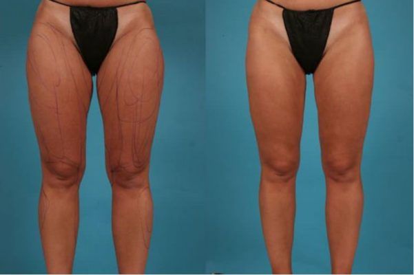 inner thigh surgery