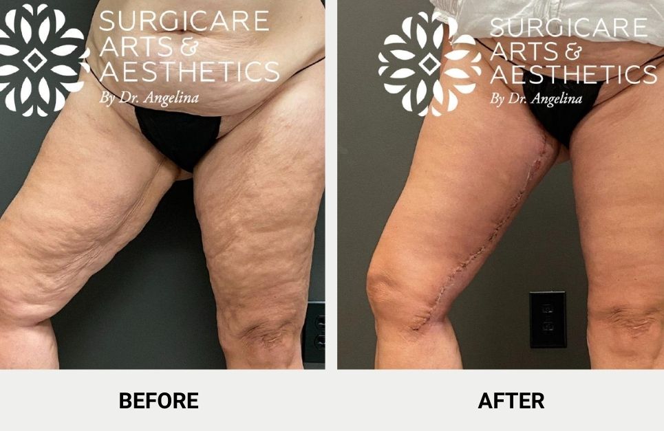inner thigh surgery