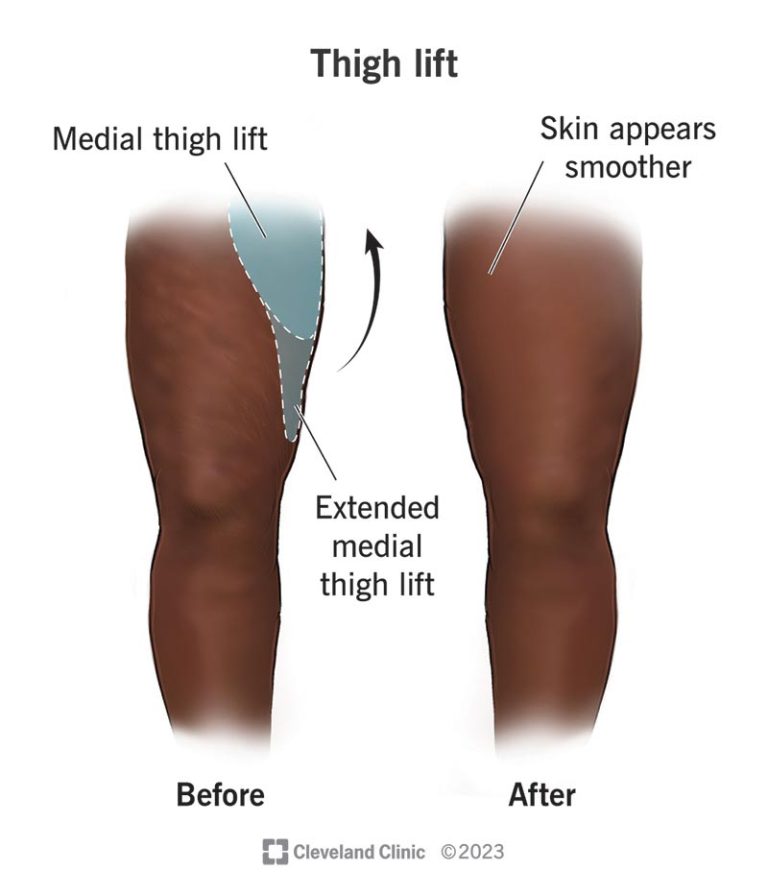Inner thigh surgery: Sculpting and toning your legs