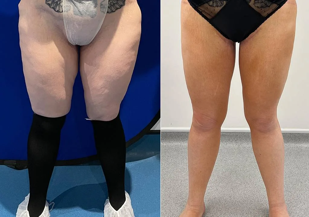 inner thigh surgery