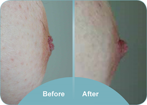 inverted nipple correction