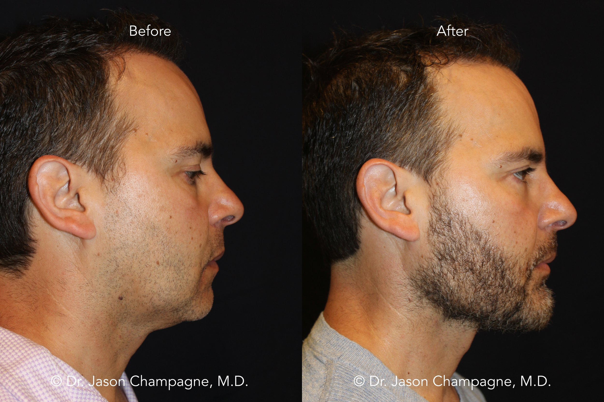 jaw augmentation