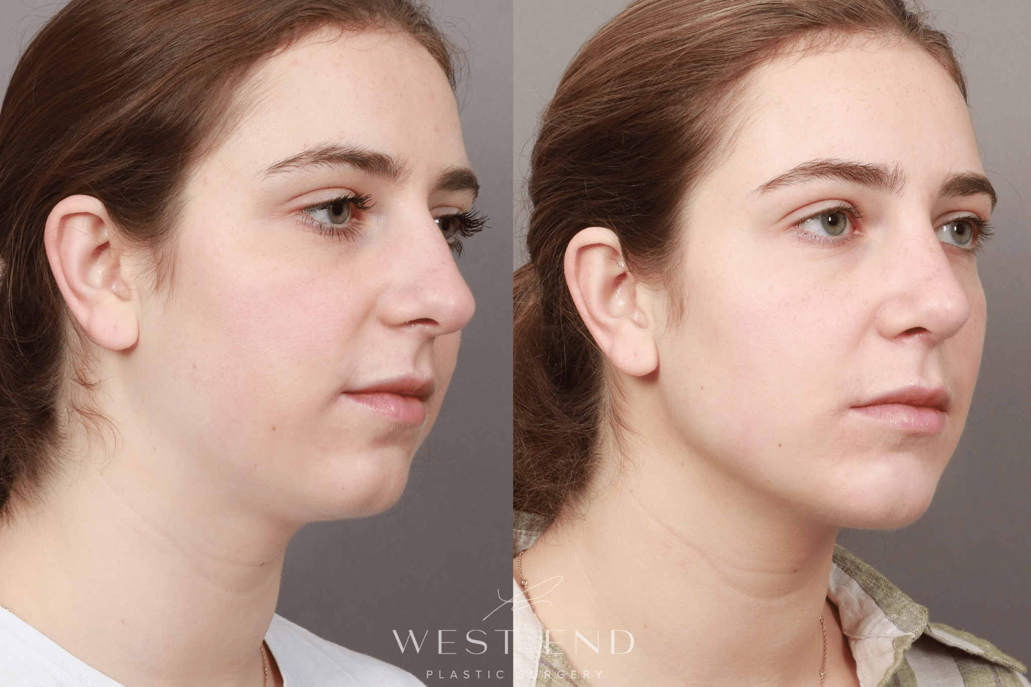 jaw augmentation