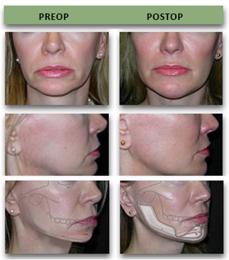 jaw augmentation