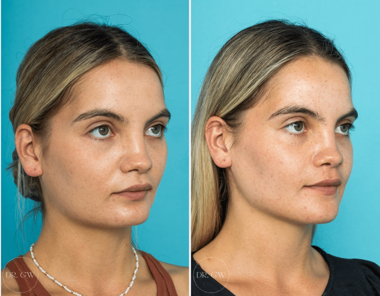 Jaw augmentation: Sculpting the perfect jawline