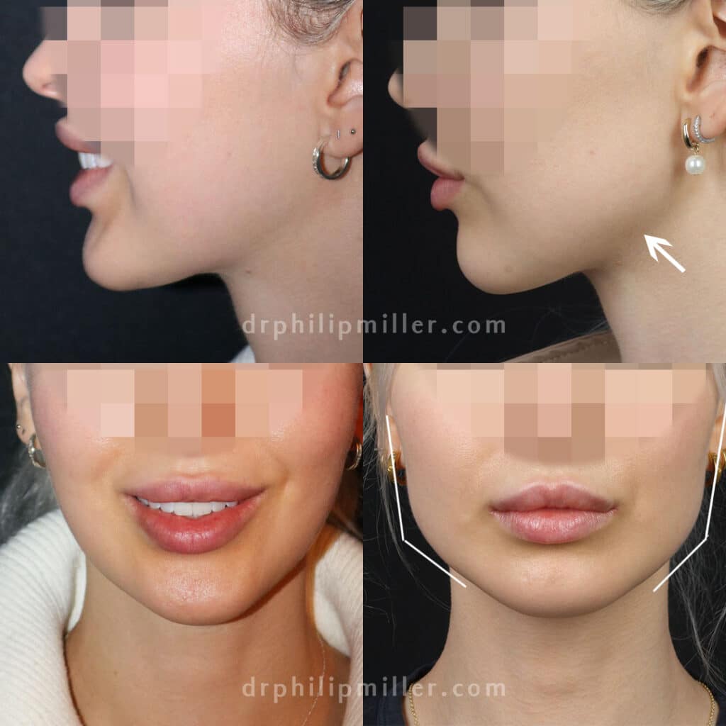 jaw augmentation