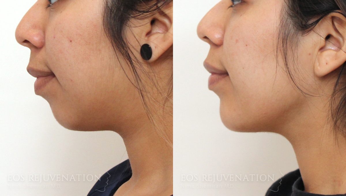 jaw liposuction