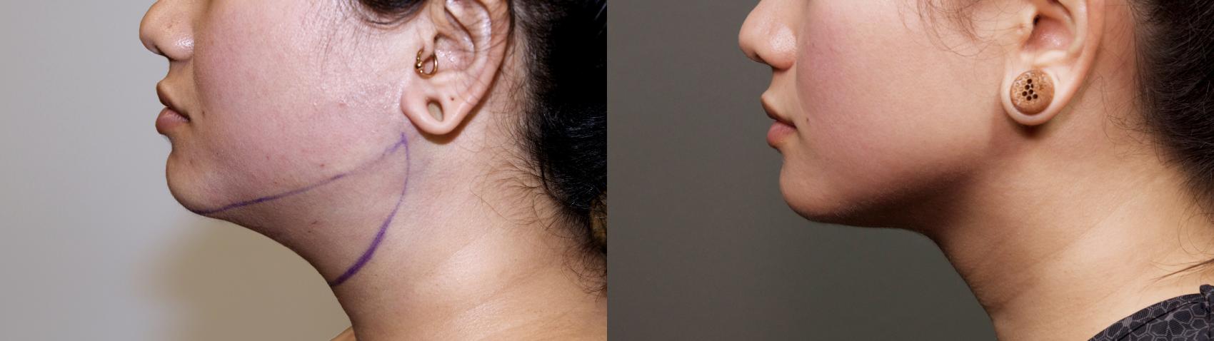jaw liposuction