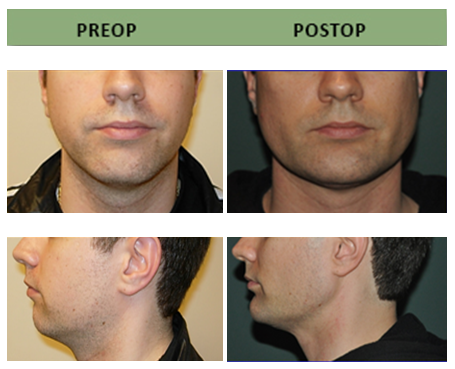 Jawline Implants: Enhancing definition and structure